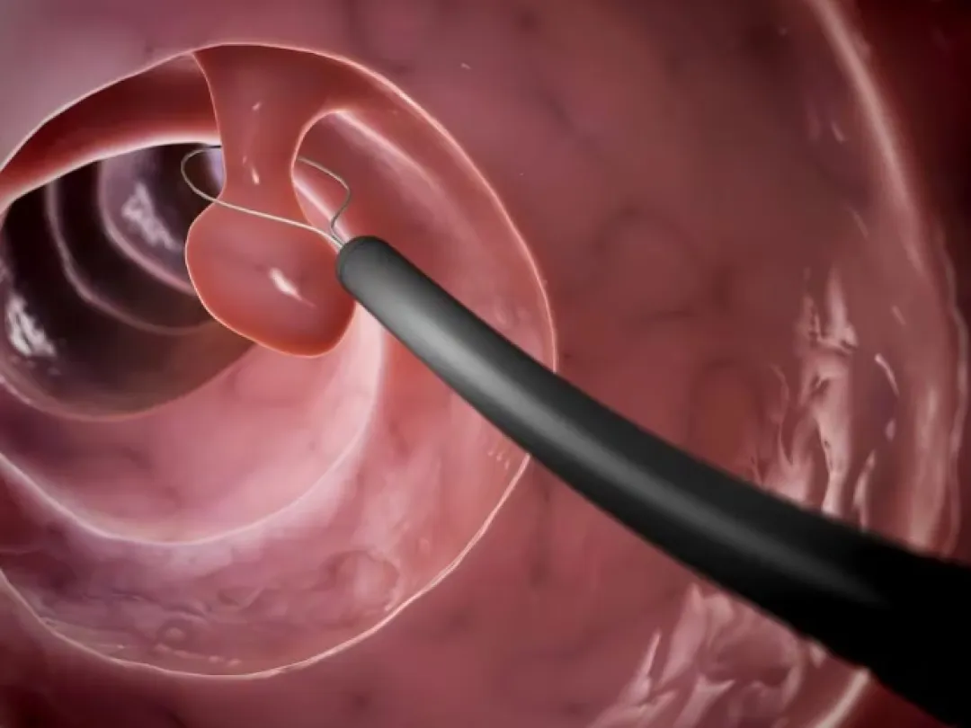 Pólipos rectales: cómo evitarlos, cuáles son los más peligrosos y cuándo llegan a cáncer